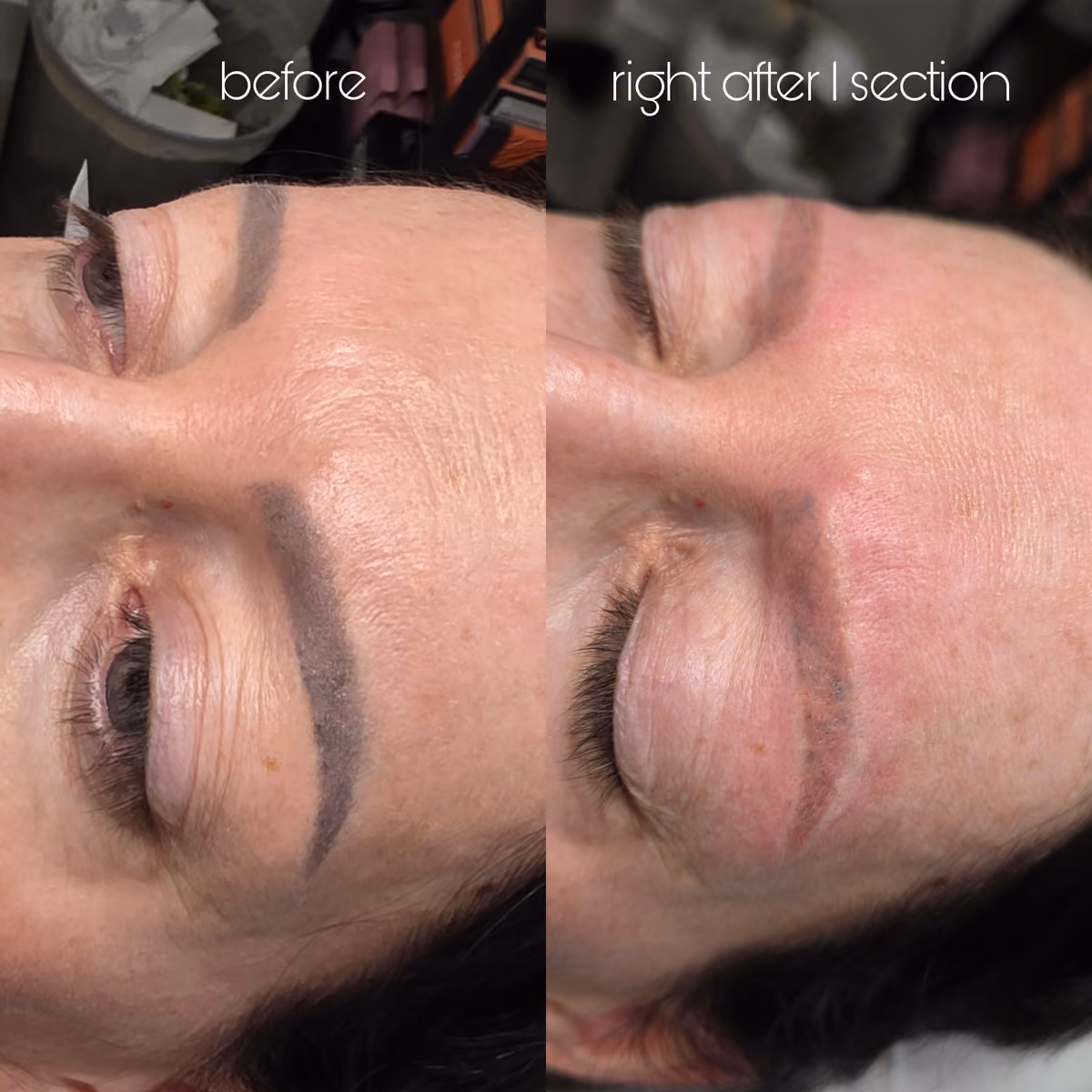 Laser removal — both brows